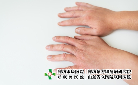 摄图网_327119749_治疗皮肤病 ţƤѢ 湿疹 皮炎 素质 在人的手上 皮肤病学方向的医学理念和治疗（企业商用）