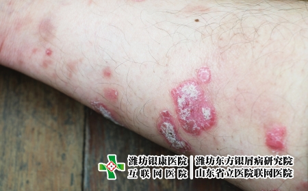 摄图网_323551459_丝虫病宏观药品疾病弯头发痒病人医疗皮肤手臂皮炎(企业商用) 摄图网_323551459_丝虫病宏观药品疾病弯头发痒病人医疗皮肤手臂皮炎(企业商用)