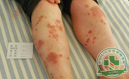 银屑病治疗常见的误区有哪些?