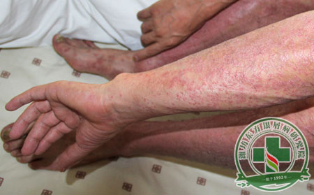 全身性银屑病应该怎样治疗?