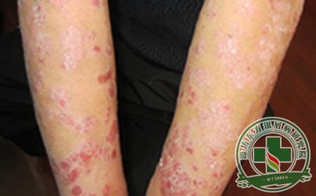 银屑病花多少钱能治可以?