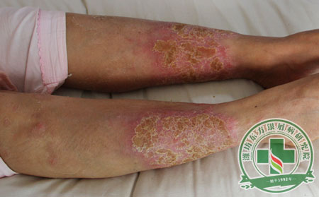 医生浅谈中医治疗银屑病注意事项