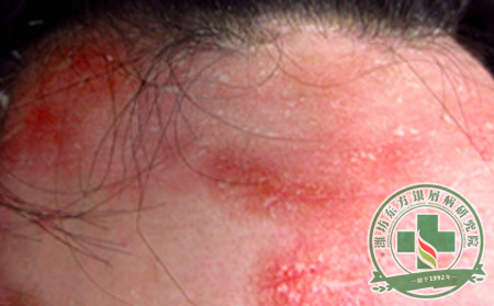 潍坊银屑病医院医生浅谈银屑病常规常识