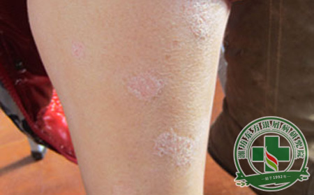 生活中哪些因素容易诱发银屑病？