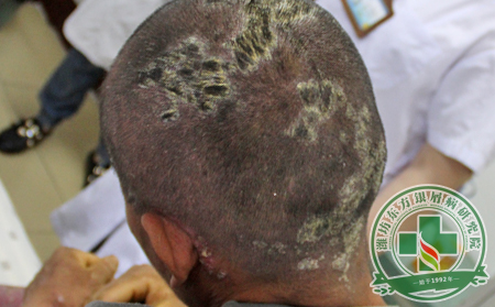 头部银屑病会传染吗?