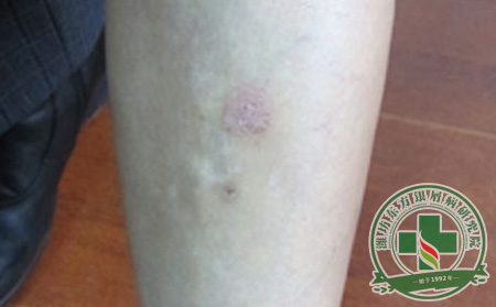 医生浅谈银屑病的父系遗传