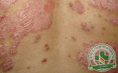 医生忠告:过度治疗不利于银屑病治可以