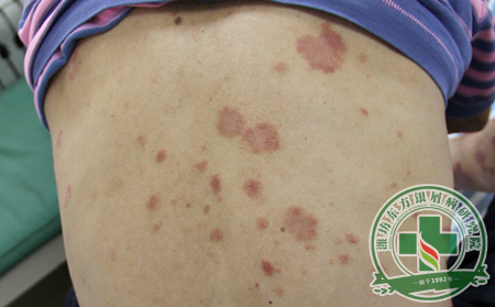 身上长了牛皮癣怎么办?