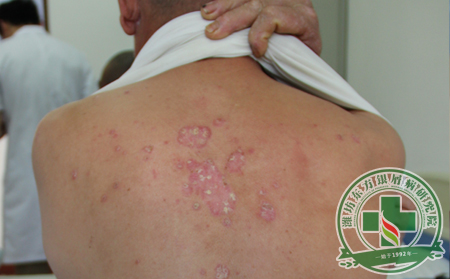 牛皮癣早期有什么症状?