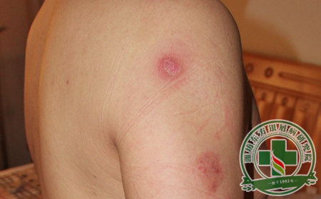 医生揭秘银屑病“幕后真凶”