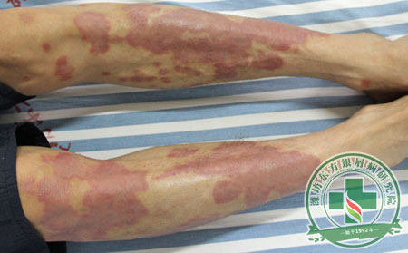 银屑病常见的并发症有哪些？