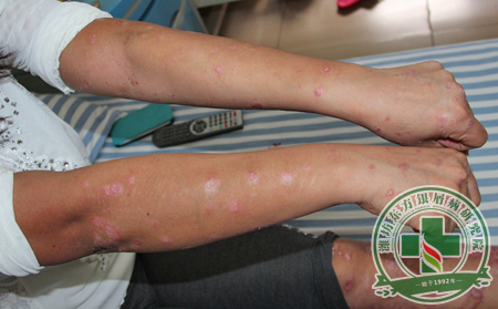 银屑病治疗应该遵循哪些原则?