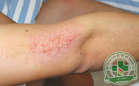 银屑病治疗应该遵循什么法则?