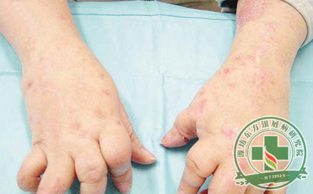 关节型银屑病怎么治疗良可以?