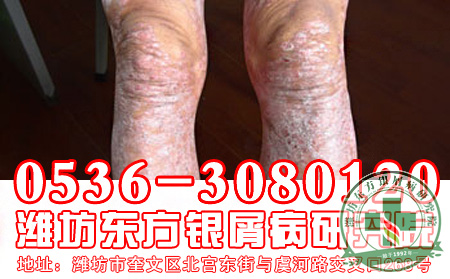 腿上长了银屑病应该怎么护理呢？