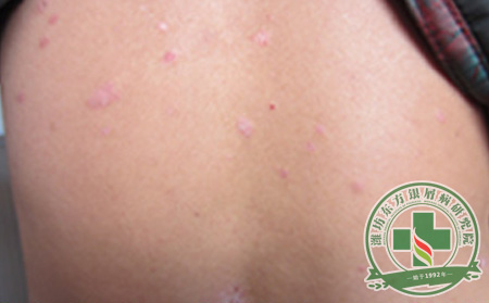 银屑病治疗不及时会造成什么后果?