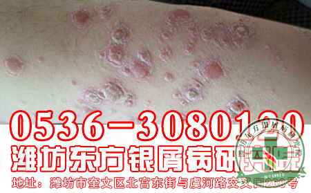 银屑病巩固治疗意义何在?