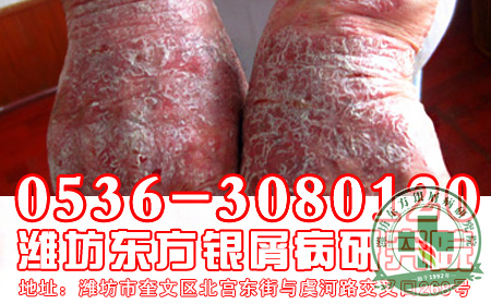 银屑病治疗不当造成怎样的后果?