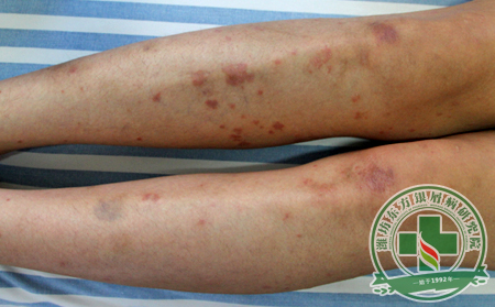 牛皮癣治疗