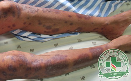 银屑病临床治疗预防关节损害