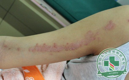 总结几个银屑病患者常见的治疗误区