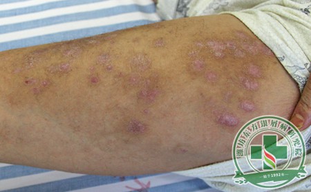 坚持治疗银屑病患者需要做到哪些方面?