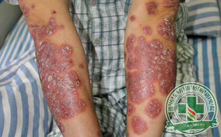 一般而言银屑病是怎样治疗的?