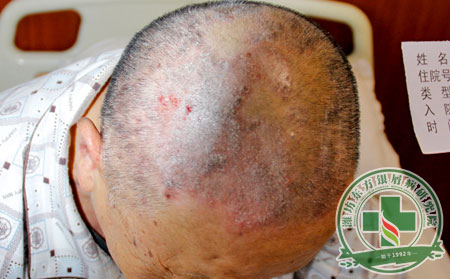 初期的银屑病不治疗能自己治可以吗