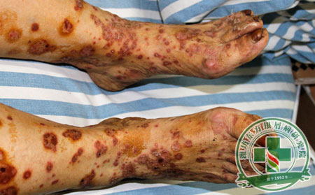 潍坊治疗牛皮癣需要多少钱?