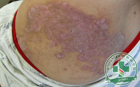 为什么牛皮癣可以使用光疗治疗