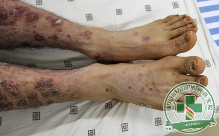 治疗牛皮癣的花费与哪些因素相关?