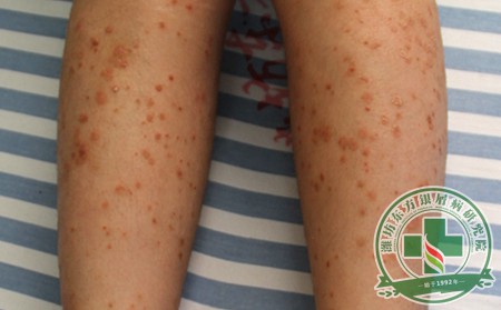 治疗银屑病的常规方法有哪几种?