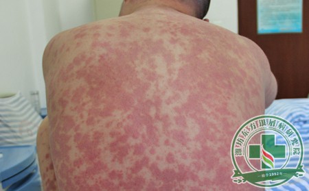 潍坊银屑病的治疗准则