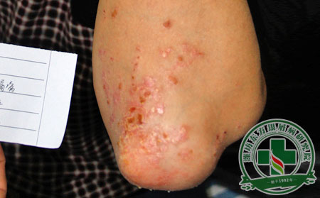 银屑病怎么治疗见到效果可以?