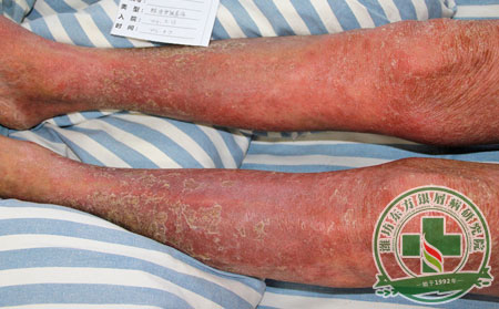 银屑病治疗方法差的原因是啥