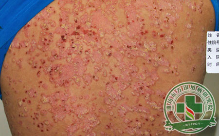 治疗银屑病的意义是什么