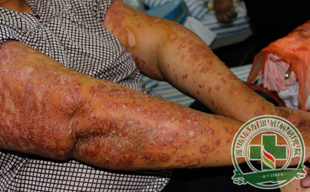 潍坊银康医院的治疗方法怎样