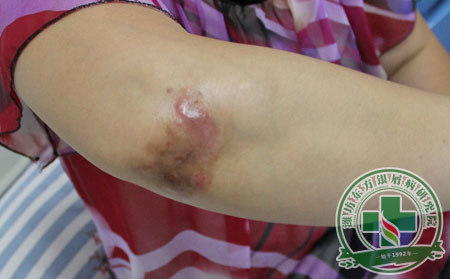 不同类型银屑病的临床表现是什么