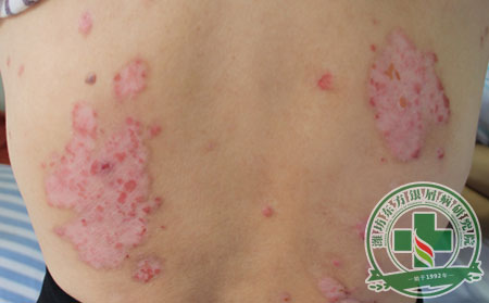 皮肤上有红斑就是牛皮癣吗