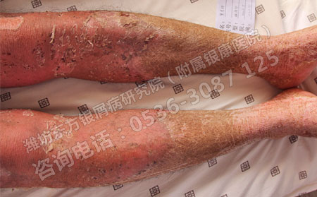 寻常型银屑病是什么情况