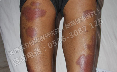 山东皮肤病银屑病临床症状表现