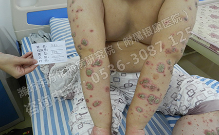 山东治牛皮癣的地方都用啥方法可以
