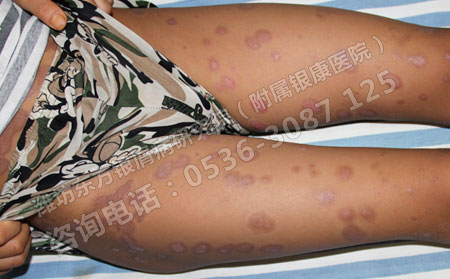 银屑病患者心理问题怎么解决