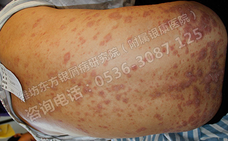 男性应该怎么预防牛皮癣的发生