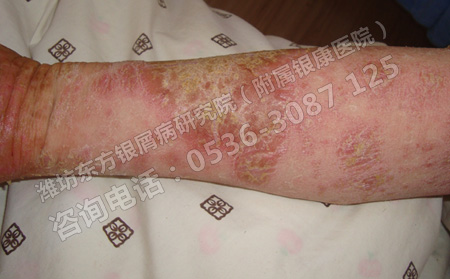 春季牛皮癣易复发如何规范治疗