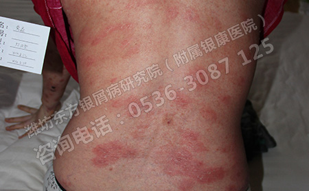 成年人得上牛皮癣能不能治可以呢?