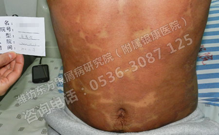急性银屑病怎么治