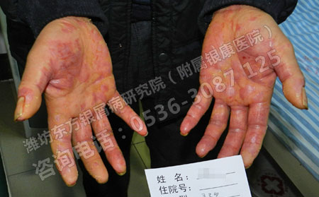 去潍坊治疗银屑病选择哪家医院可以