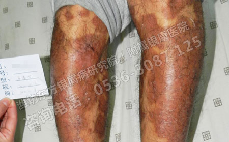 银屑病患者春季护理六字经