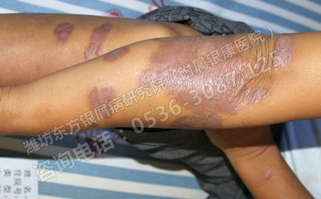 牛皮癣病情可以转的症状是什么